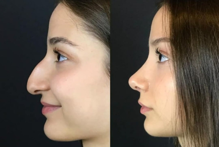 How long does a non surgical nose job last